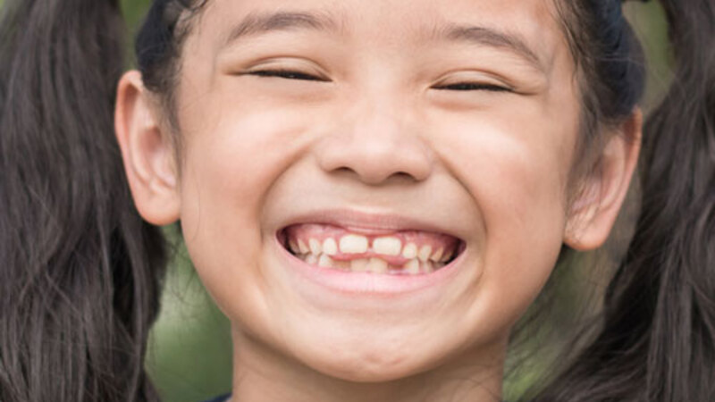 Tongue Thrusting Habit